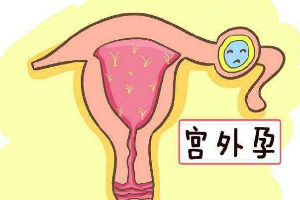 宫外孕症状早期_造成宫外孕的原因