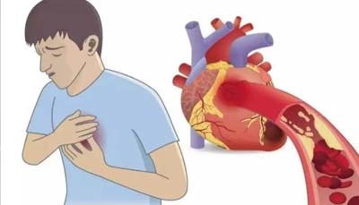 心肌梗死的病因有哪些
