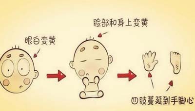 新生儿黄疸怎么办